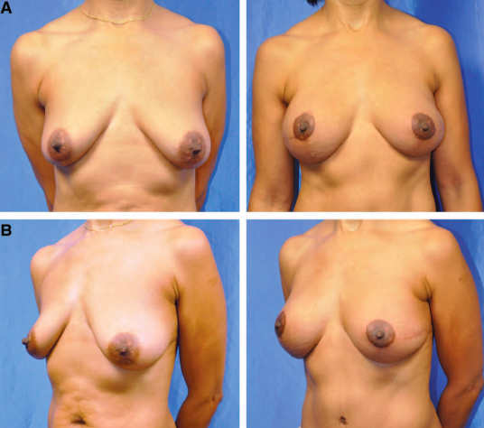 A, B foto pre Mastectomia bialterale e ricostruzione con Lembo DIEP bialterale  (a destra il post a 3 mesi)